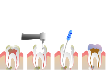 Root Canal Therapy