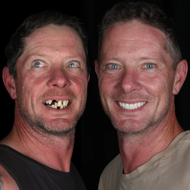 before and after dental implants Melbourne