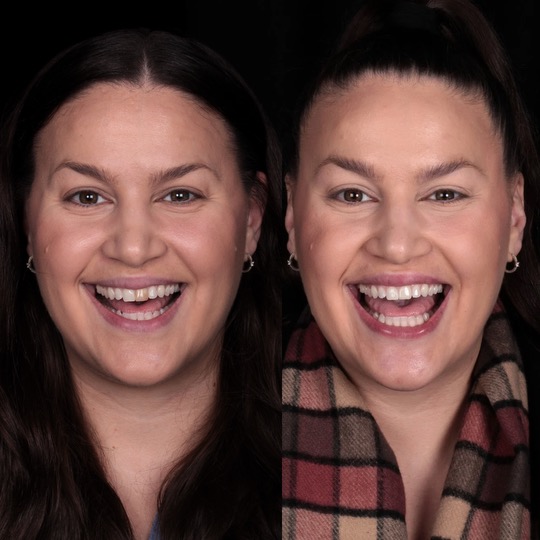 before & after teeth whitening Melbourne