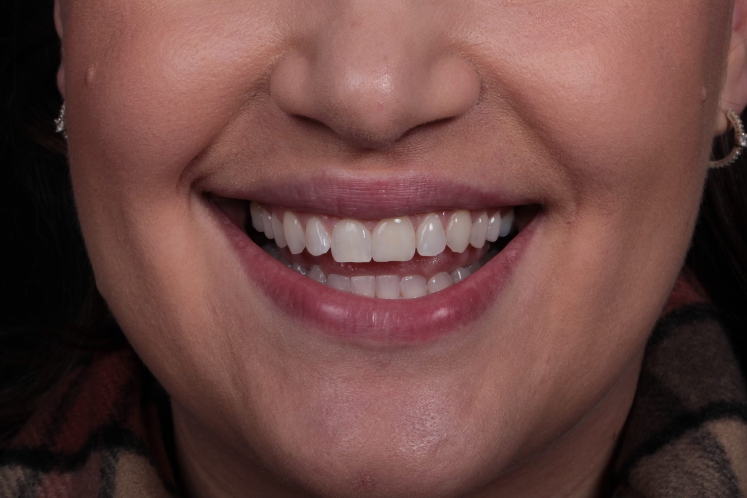 teeth whitening Melbourne