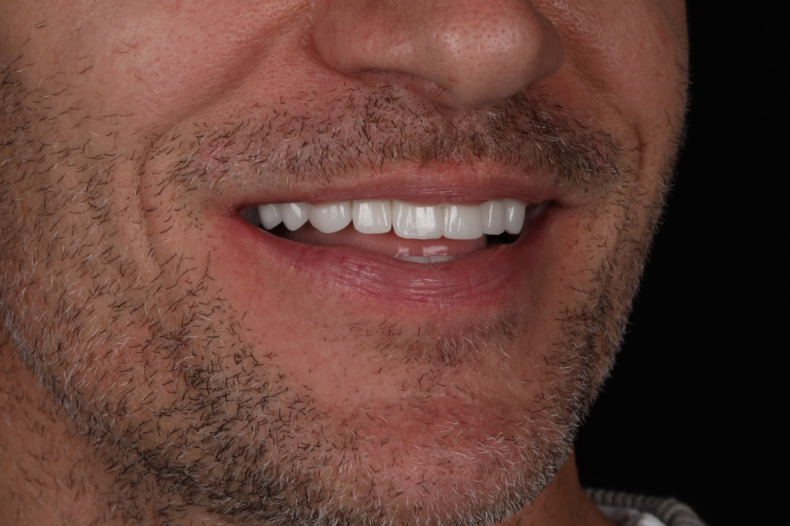 Dental Crowns B&A