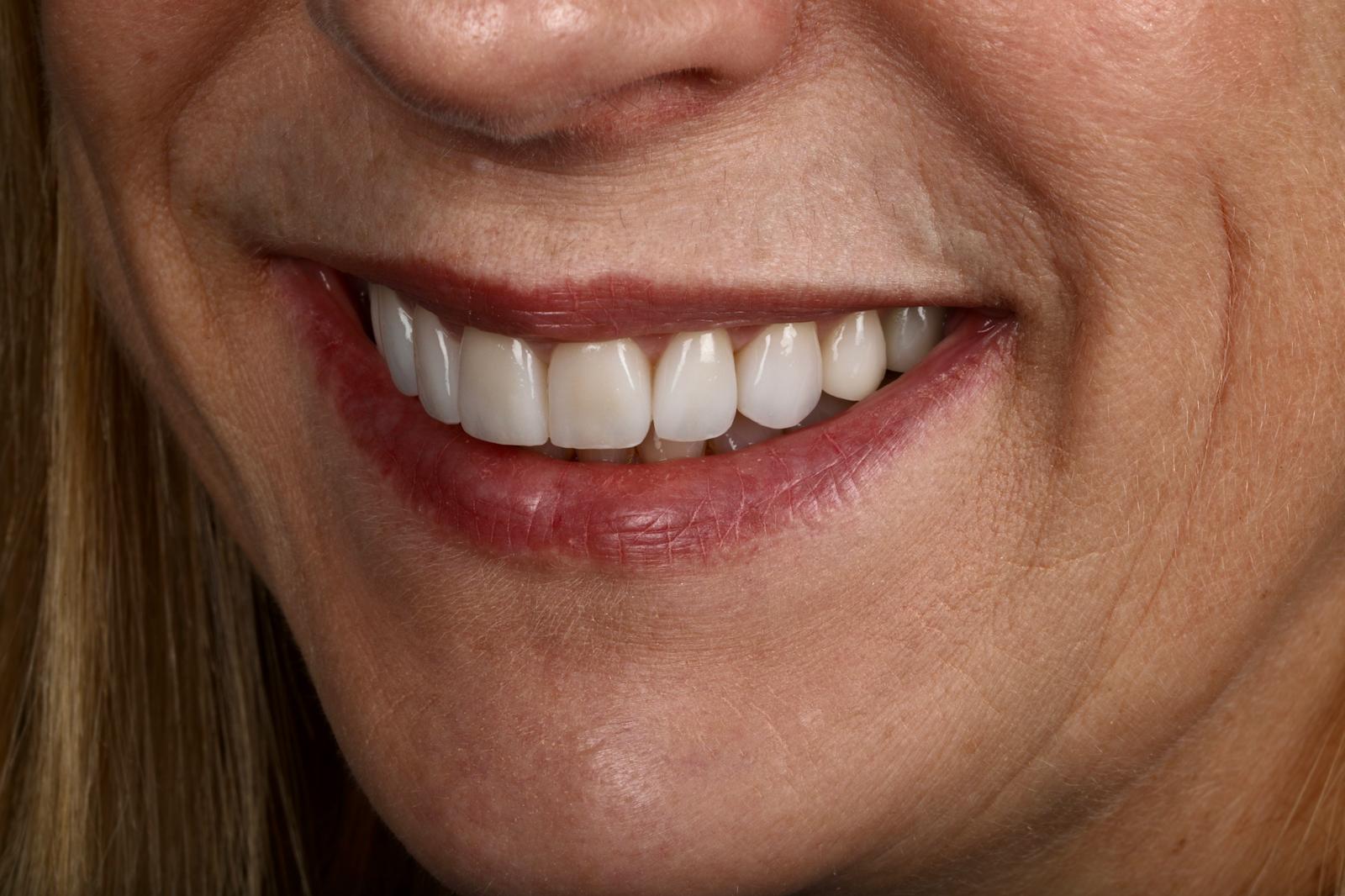 Porcelain Veneers After
