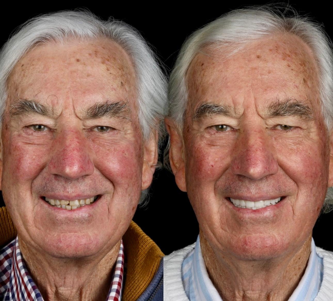 Dental Crowns - Before & After